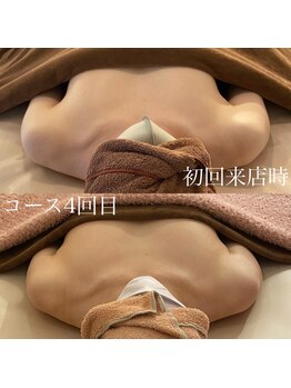 森の時計/症例写真:バスト編　コース4回目