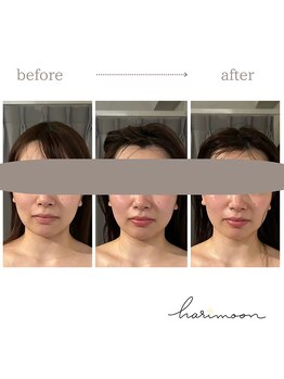 ハリムーン 仙台(harimoon)/ブライダルビフォーアフター