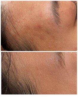 リノア(LINORE)/ハーブピーリング(剥離なし)6回