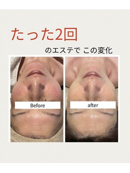 インチャント(enchant)/乾燥からの悩み 水光2回の結果