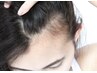 【育毛促進ヘアシステムケア】抜け毛/頭皮のお悩みに！90分¥11000