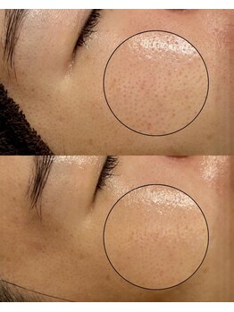 エル(Elle)/【毛穴改善】毛穴の開き/黒ずみ