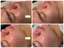 ベルドア(Bell Door)/ニキビケア/毛穴