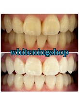 ホワイトニングショップ 山形店(Whiteningshop)/学割でお得にホワイトニング