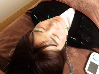 ばば鍼灸院の写真/美容鍼でお肌のたるみやシワを改善しハリツヤUP♪お顔がリフトアップされ小顔効果&エイジングケアにも◎