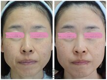 アンレミューラボ(Un Lemieux Labo)/凸凹跡、毛穴改善