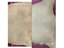 プリマプリート 各務原店/ブライダルエステ背中ニキビケア