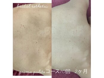 プリマプリート 各務原店/ブライダルエステ背中ニキビケア