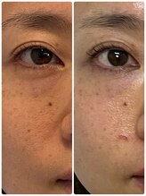 ルミア(LUMIA)/小顔造形ロイヤル