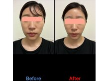 ガネェーシャ(Ganesha)/お顏のもたつきを瞬時に解決