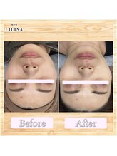 ウィズリリナ 新横浜(with Lilina.)/1回/ハーブピーリング/新横浜