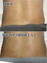 ルシャトン(Le Chaton)/背中脱毛(腰)