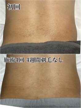 ルシャトン(Le Chaton)/背中脱毛(腰)