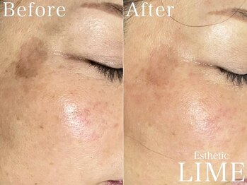 ベル 後楽園 春日(Belle)/毛穴洗浄｜ハーブピーリング