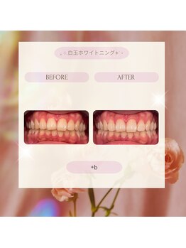 プラスビーセルフ(+b self)/ホワイトニングビフォーアフター
