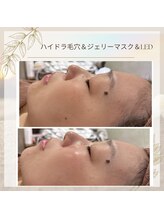 エステテックサロンラレーヌ 小山店(La Reine)/ハイドラ毛穴＆LED