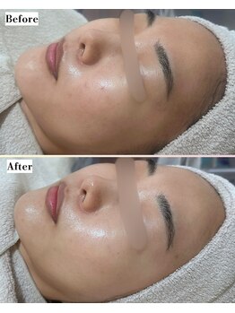 ソワナ(soina)/【神楽坂駅/フェイシャル/毛穴】