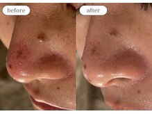 リスタ(RSTA)/【BEFORE/AFTER】