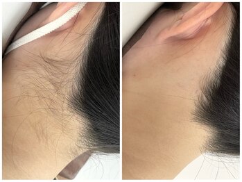 脱毛アンドフェイシャルサロン ルアーナ 心斎橋(LUANA)/うなじ美人ケア