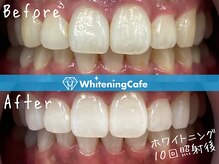 ホワイトニングカフェ 天王寺あべの店(WhiteningCafe)の雰囲気（初めての方にも◎自然な白い歯へ♪ホワイトニングBefore→After）