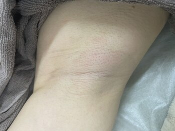 ナノハナ/鹿沼市全身脱毛美容室ナノハナ