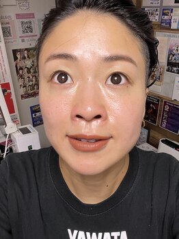 ライトビューティー 本八幡店(LIGHT BEAUTY)/日サロに通っていた36歳の肌です