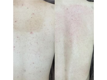 ニキビケア研究所 所沢店/背中ニキビケアもお任せください