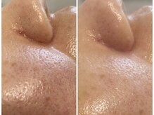 ニコ アンド キャンディー(Nico.&Candy)/光フェイシャル　本厚木/脱毛