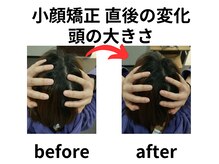 ほねつぎ 平成けやき通り鍼灸接骨院/小顔矯正で頭が小さくなりました