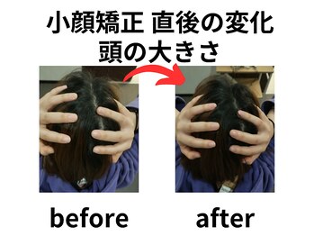ほねつぎ 平成けやき通り鍼灸接骨院/小顔矯正で頭が小さくなりました