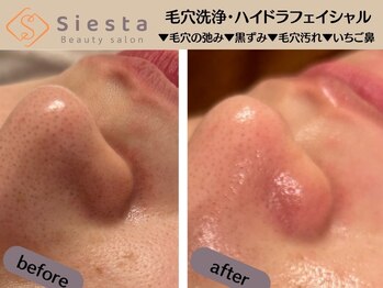 シエスタ(siesta)/再ブーム到来の毛穴洗浄！