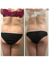 リボディ プラチナ(Rebody platinum)/ボディスカルプト×ボディケア