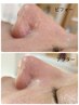 【学割U24】　　気になる毛穴黒ずみゴッソリ除去