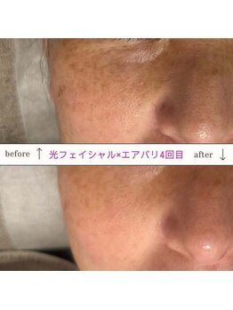 キュオバイアンドリープ(Qo by &LEAP)/光フェイシャル×エアバリ