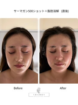 シャムリー(SHAMRY)/サーマガン500ショット