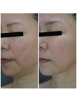 Nビューティー/最新RFサーモシェイプオーパス