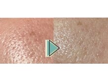 ピーチ ローズ(peach rose)/立毛筋／ニキビ／毛穴／