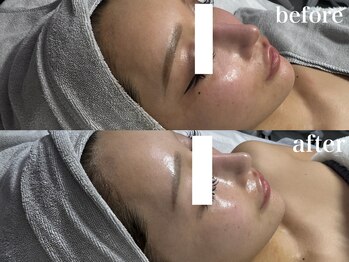 ナチュールムーン(Nature moon.)/ハーブピーリング