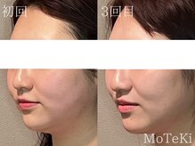 モテキ 表参道店(MoTeKi)/症例Befor/Afterカンナムリフト
