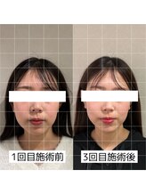 ヴィーライン 大阪梅田院(VeLine)/鍼灸／美容鍼／小顔／大阪／梅田