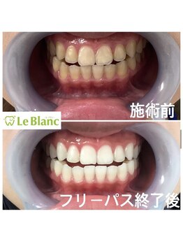 ルブラン 奈良店(Le Blanc)/イベントに向けて歯を白く！