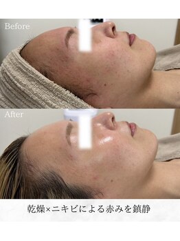 シロ(silo)/手強い赤みもすっきり鎮静!