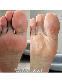 フットミー(foot mii)/見た目も痛みも◎