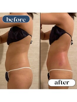 オーロラ(Aurora)/痩身ダイエットコースの1回目