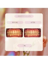 プラスビーセルフ(+b self)/ホワイトニングビフォーアフター