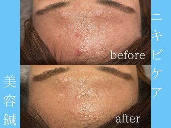 ビープラス(BEE PLUS)/ニキビケア