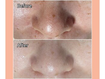 ベルミーランド 浜松天王/フェイシャルBefore→After