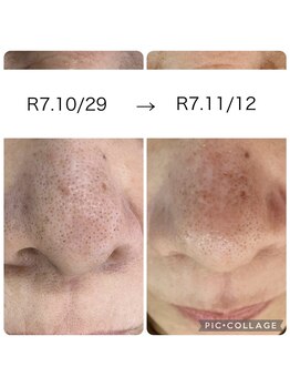 カピリナ(kapilina)/鼻の黒ずみ改善例