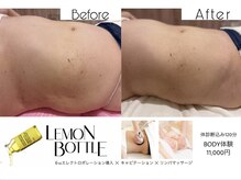 レモンボトル6cc導入×リンパで、頑固な重い脂肪も薄くなる！