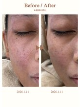 ルポ(Repos)/レディースエステシェービング